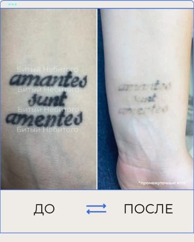 Удаление татуировки